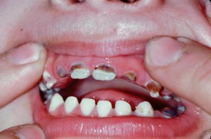 baby bottle tooth decay