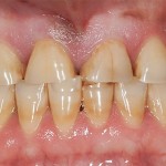 bruxism