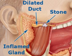 salivary-gland-stones1