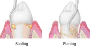 scaling-and-planing