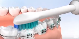 best-electric-toothbrush-for-braces