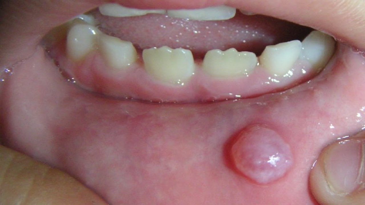 Mucocele The Dental Arcade Blog